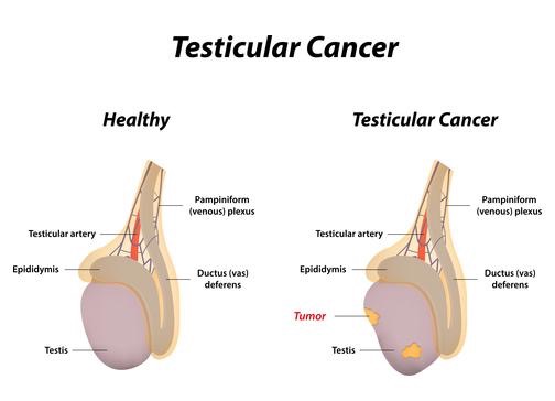 testicular-cancer
